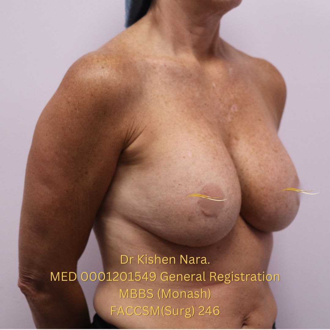 Revision breast implants — Left oblique view — before
